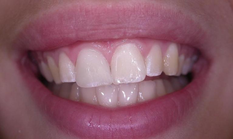 Dental-Bonding-After-Image