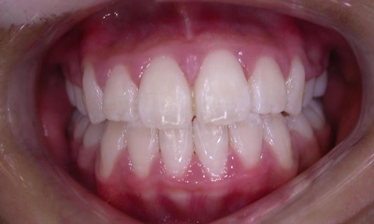 Orthodontics-After-Image