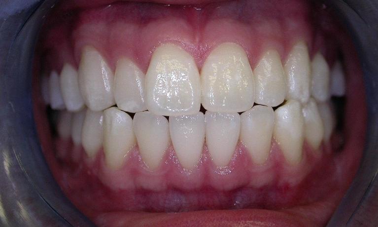 Teeth-Whitening-After-Image