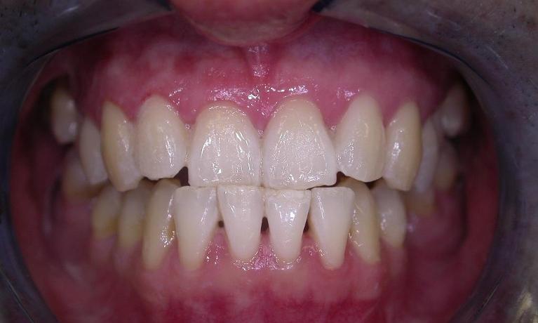 Teeth-Whitening-After-Image