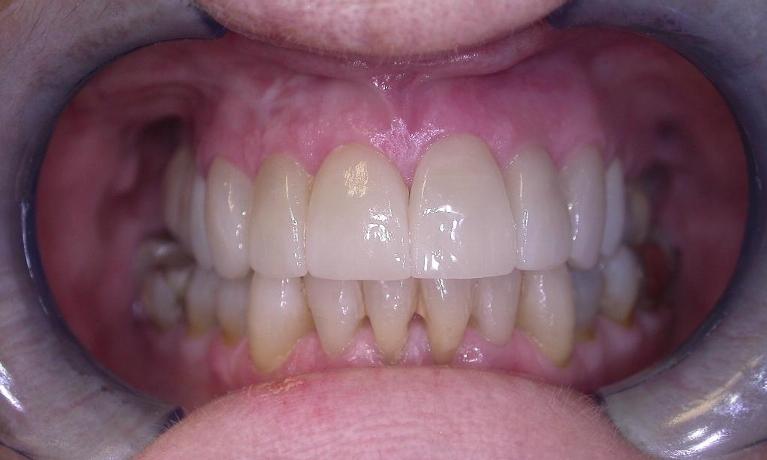 Veneers-After-Image