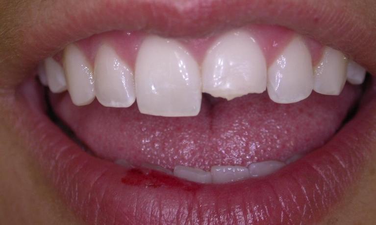 Dental-Bonding-Before-Image