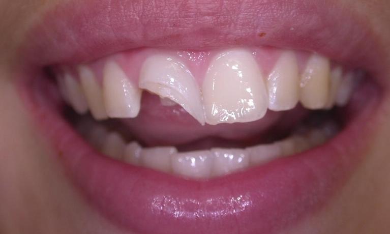 Dental-Bonding-Before-Image