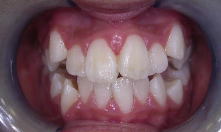 Orthodontics-Before-Image