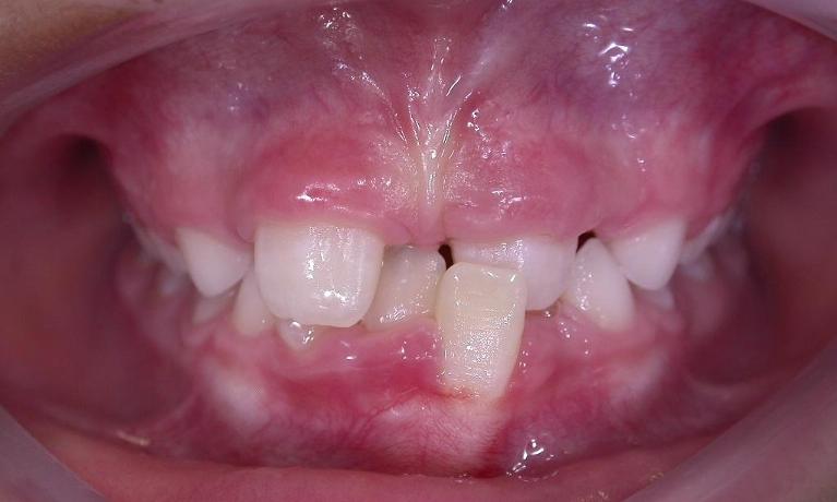 Orthodontics-Before-Image