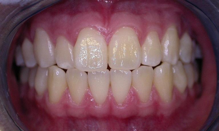 Teeth-Whitening-Before-Image