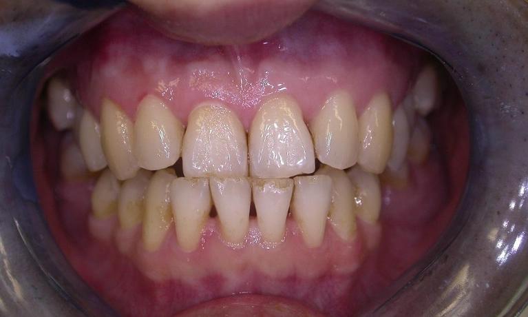 Teeth-Whitening-Before-Image