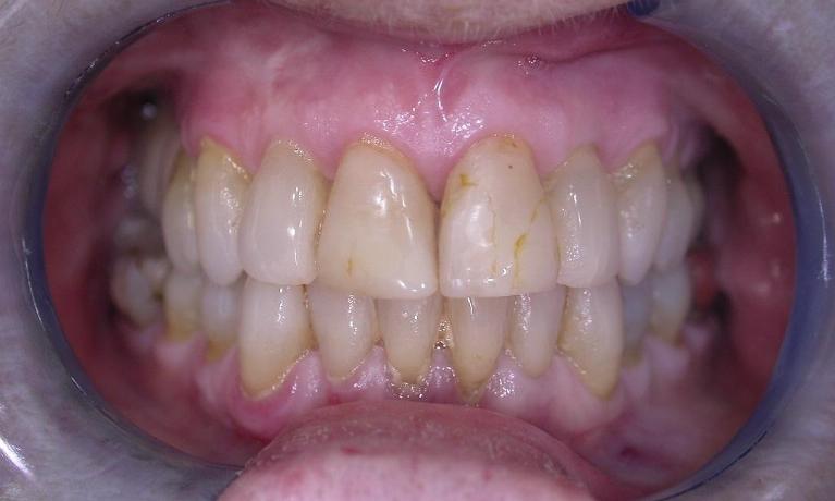Veneers-Before-Image